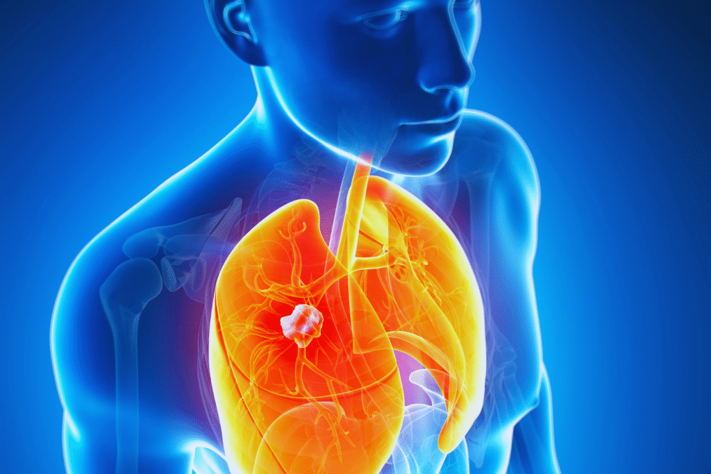 principais doenças que geram Isenção do Imposto de Renda